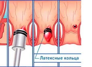 Ligirovaniye gemorroya