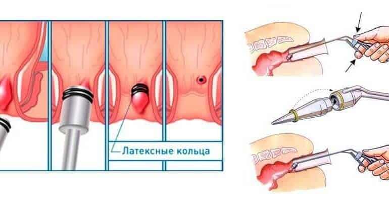 Плавание – профилактика геморроя и путь к здоровью