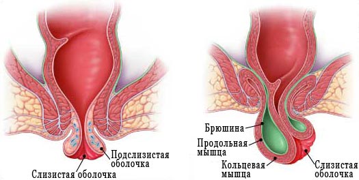 Выпадение прямой кишки во время дефекации схема